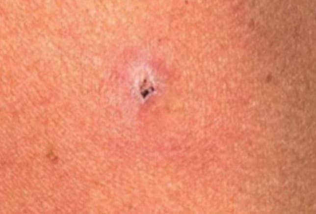 The treated area before treatment