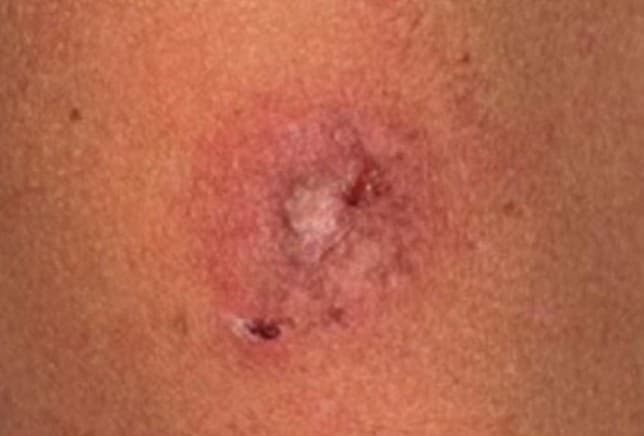 The treated area during the course of treatment