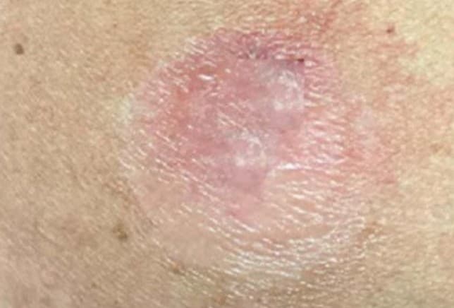 The treated area on the last day of treatment