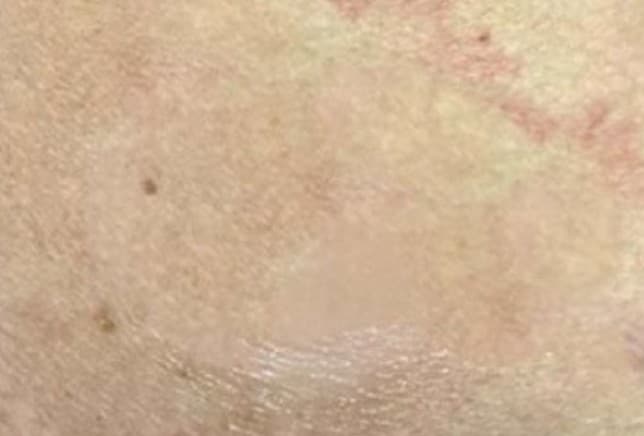 The treated area two months after treatment